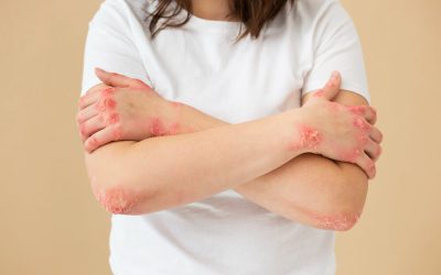 Eczema: The Physical and Psychological Challenges During Adolescence