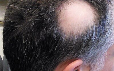 Comprehending the Pathophysiology, Etiology, and Treatment Strategies of Alopecia
