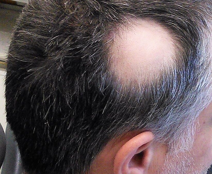Comprehending the Pathophysiology, Etiology, and Treatment Strategies of Alopecia