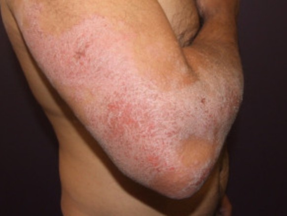 Atopic Dermatitis Eczema Dermcare Dermatology Quincy 1